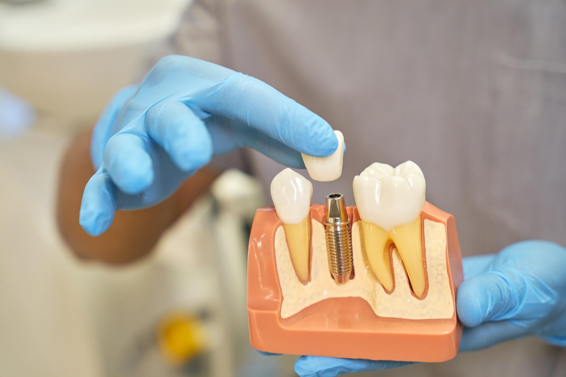 Dental Implants Treatment