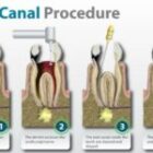 Unraveling the Truth Behind Root Canal Treatment