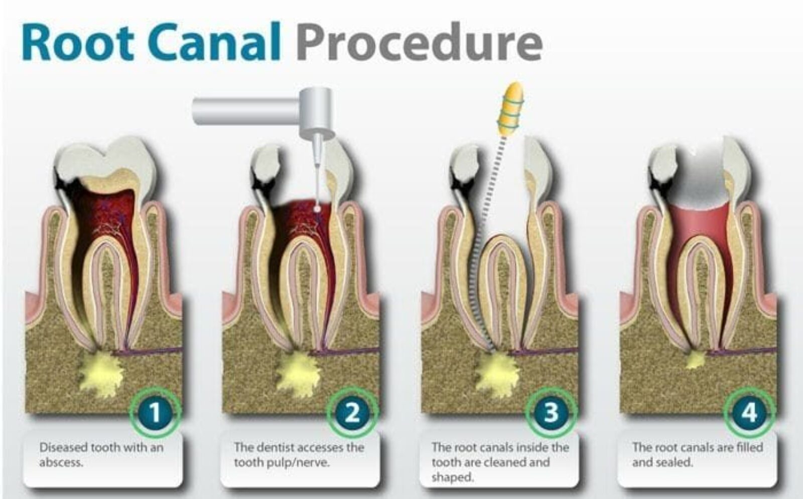 Root Canal Specialist Near Me