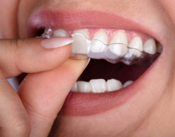 Close-up Of A Woman's Hand Putting Transparent Aligner In Teeth