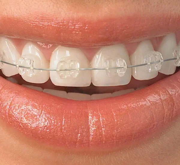 Invisalign-ceramic-braces-0