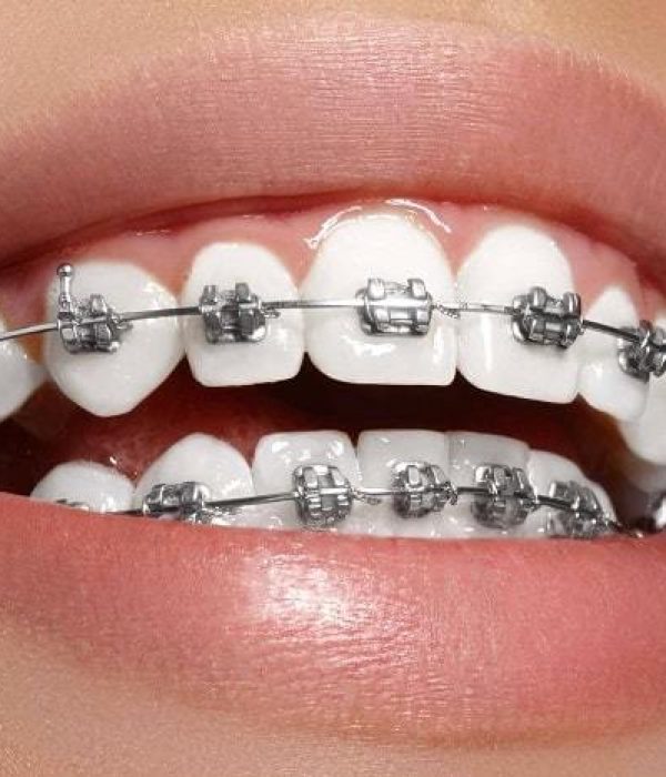 Metal-brace-to-align-and-straighten-crowded-teeth-min-1