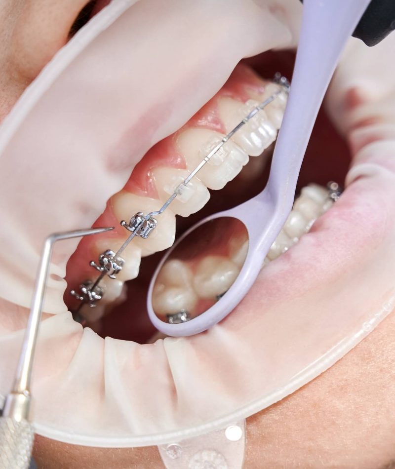 dentist-attaching-metal-braces-patient-teeth (1)