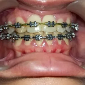 fixed-braces-with-metal-brackets-500x500