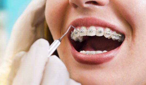 Closeup young woman checking her braces, smiling