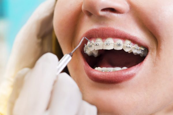 Closeup young woman checking her braces, smiling