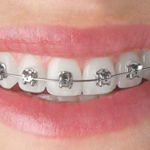 metallic-braces