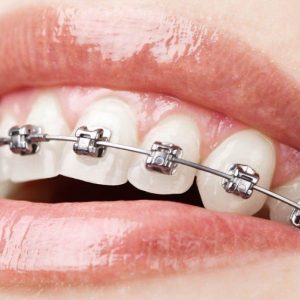 understanding-metal-braces (1)